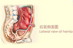 Hernia
